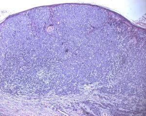 Cellula Melanoma