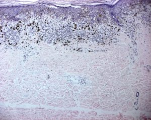 Cellula Melanoma