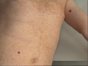 Colore Variabile Lesione