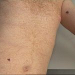 Lesione Melanocitaria
